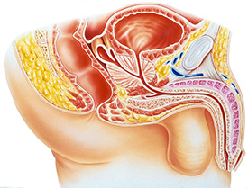 Premium Vector  Vasectomy surgical intervention birth control and  contraception through sterilization of men